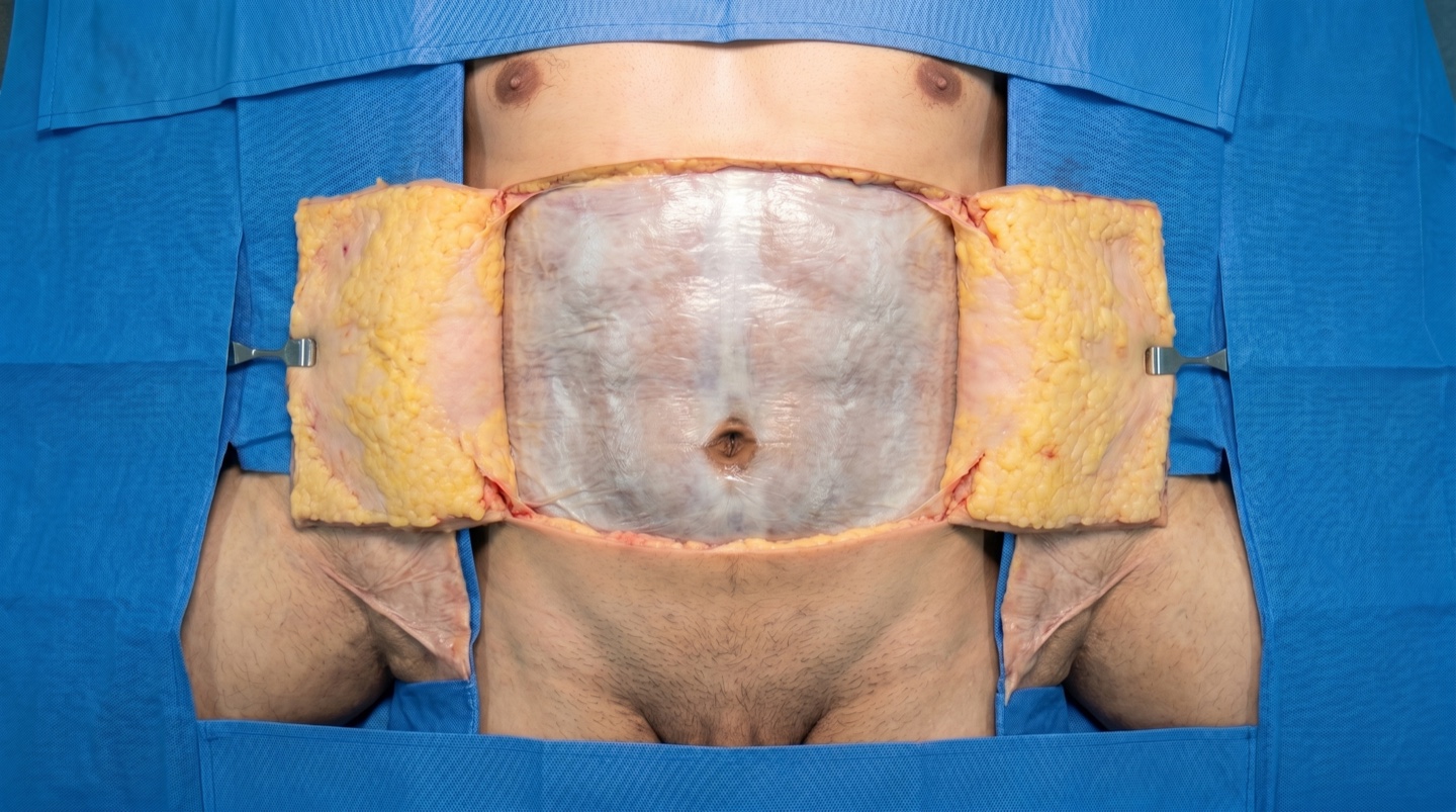 Skin & superficial fascia