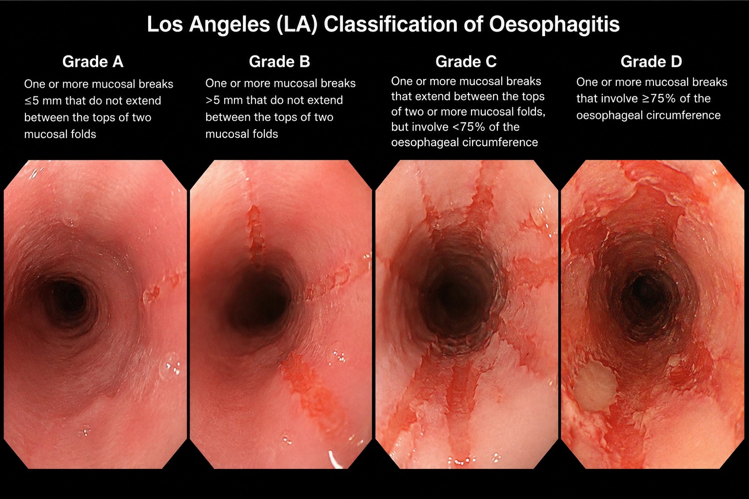 Los Angeles classification of oesophagitis, grades A to D, shown as endoscopic views with definitions