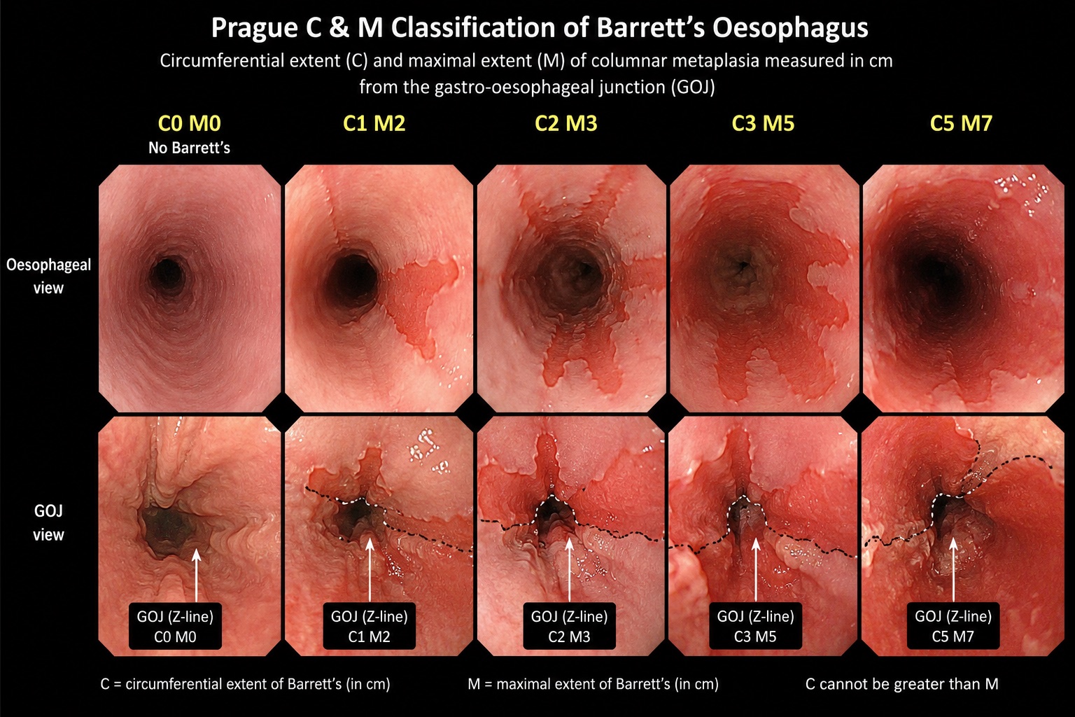 Prague C and M classification of Barrett’s oesophagus, showing oesophageal and gastro-oesophageal junction views from C0 M0 to C5 M7
